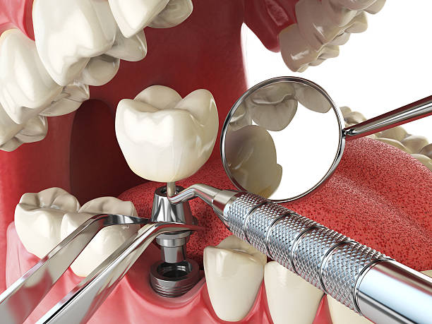 Best Emergency Dentist for Lost Fillings or Crowns in Pleak, TX